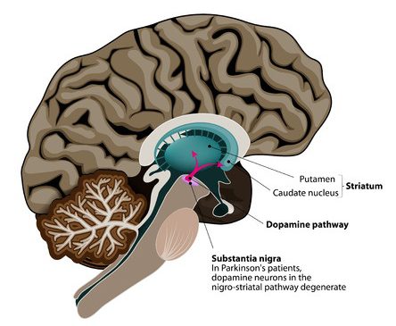 33194756 - parkinson's disease. cross-section of the human brain showing the substantia nigra, the region affected by parkinson's disease. illustration shows neuronal pathways that degenerate in parkinson's disease.